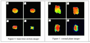 Cifra 4: transverse section proton density-weighted images at different point-in-time Figure 5: coronal plane proton density-weighted images at different point-in-time